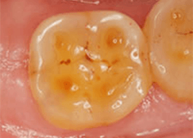 佐賀市の歯医者、佐賀ん歯科・こども歯科で歯ぎしりの治療