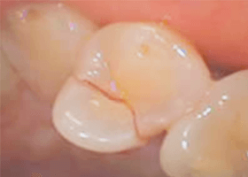 佐賀市の歯医者、佐賀ん歯科・こども歯科で歯ぎしりの治療