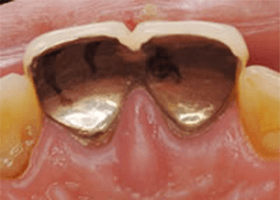 佐賀市の歯医者、佐賀ん歯科・こども歯科で歯ぎしりの治療