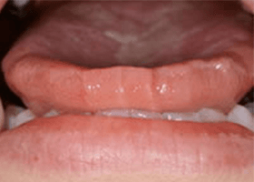 佐賀市の歯医者、佐賀ん歯科・こども歯科で歯ぎしりの治療