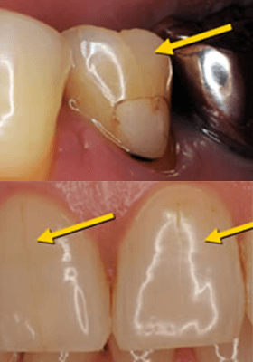 佐賀市の歯医者、佐賀ん歯科・こども歯科で歯ぎしりの治療