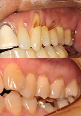 佐賀市の歯医者、佐賀ん歯科・こども歯科で歯ぎしりの治療