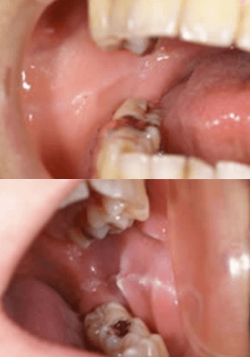 佐賀市の歯医者、佐賀ん歯科・こども歯科で歯ぎしりの治療