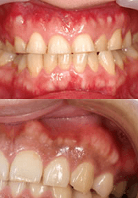 佐賀市の歯医者、佐賀ん歯科・こども歯科で歯ぎしりの治療