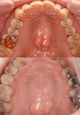 佐賀市の歯医者、佐賀ん歯科・こども歯科で歯ぎしりの治療