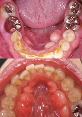 佐賀市の歯医者、佐賀ん歯科・こども歯科で歯ぎしりの治療