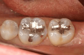 佐賀市の歯医者、佐賀ん歯科・こども歯科でむし歯治療