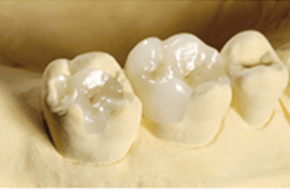 佐賀市の歯医者、佐賀ん歯科・こども歯科でむし歯治療