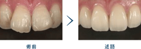 佐賀市の歯医者、佐賀ん歯科・こども歯科でむし歯治療