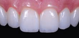 佐賀市の歯医者、佐賀ん歯科・こども歯科でむし歯治療