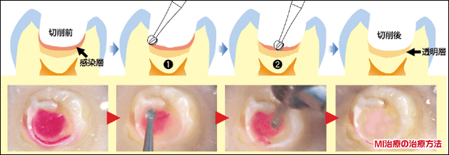 佐賀市の歯医者、佐賀ん歯科・こども歯科でむし歯治療
