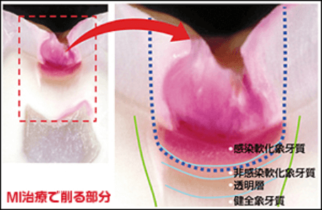 佐賀市の歯医者、佐賀ん歯科・こども歯科でむし歯治療
