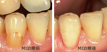 佐賀市の歯医者、佐賀ん歯科・こども歯科でむし歯治療
