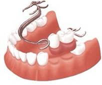 佐賀市の歯医者、佐賀ん歯科・こども歯科で入れ歯治療