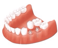 佐賀市の歯医者、佐賀ん歯科・こども歯科でインプラント治療