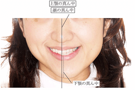 佐賀市の歯医者、佐賀ん歯科・こども歯科で入れ歯治療