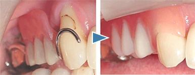 船堀（東京都江戸川区）の歯医者で予防歯科