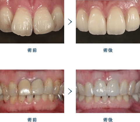 佐賀市の歯医者、佐賀ん歯科・こども歯科で審美歯科