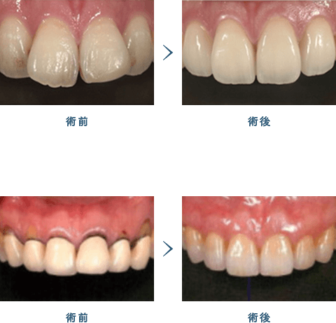 佐賀市の歯医者、佐賀ん歯科・こども歯科で審美歯科