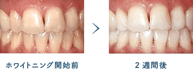 佐賀市の歯医者、佐賀ん歯科・こども歯科で審美歯科