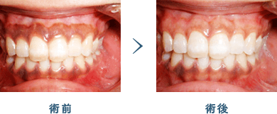 佐賀市の歯医者、佐賀ん歯科・こども歯科で審美歯科