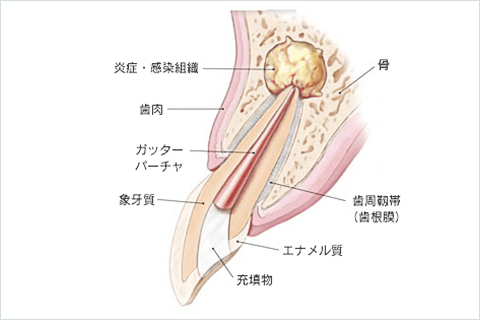 佐賀市の歯医者、佐賀ん歯科・こども歯科で精密根管治療