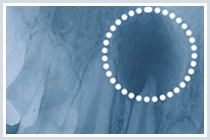 佐賀市の歯医者、佐賀ん歯科・こども歯科で精密根管治療