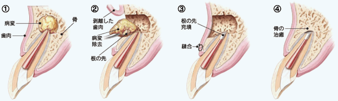 佐賀市の歯医者、佐賀ん歯科・こども歯科で精密根管治療