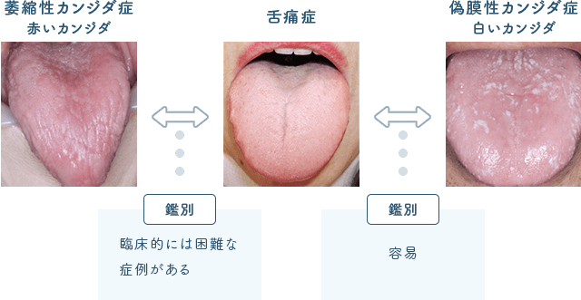 佐賀市の歯医者、佐賀ん歯科・こども歯科で舌痛症の治療