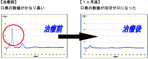 佐賀市の歯医者、佐賀ん歯科・こども歯科の口臭専門外来