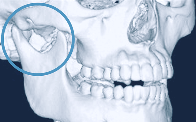 佐賀市の歯医者、佐賀ん歯科・こども歯科で顎関節症の治療