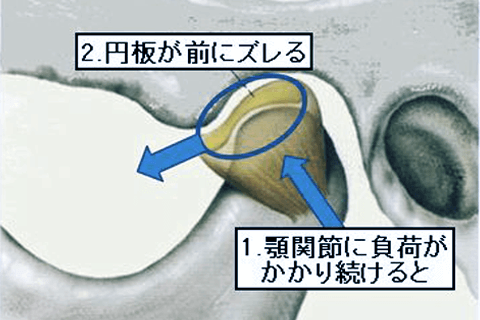 佐賀市の歯医者、佐賀ん歯科・こども歯科で顎関節症の治療