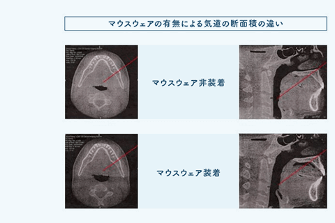 佐賀市の歯医者、佐賀ん歯科・こども歯科でスポーツ用マウスピースの作製