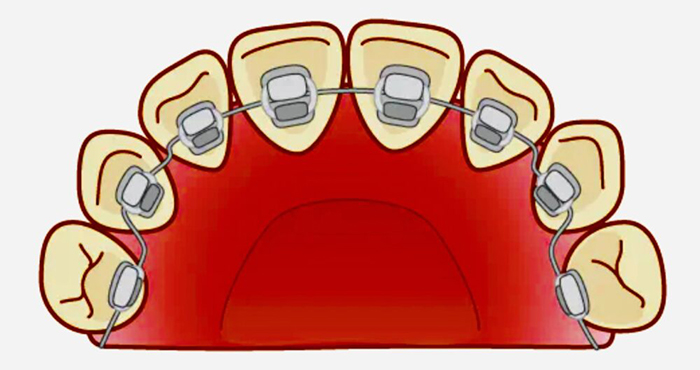 佐賀市の歯医者、佐賀ん歯科・こども歯科で矯正歯科