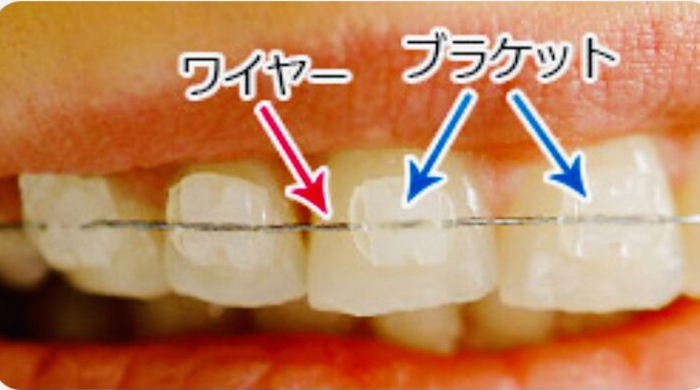 佐賀市の歯医者、佐賀ん歯科・こども歯科で矯正歯科