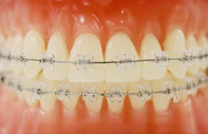 佐賀市の歯医者、佐賀ん歯科・こども歯科で矯正歯科