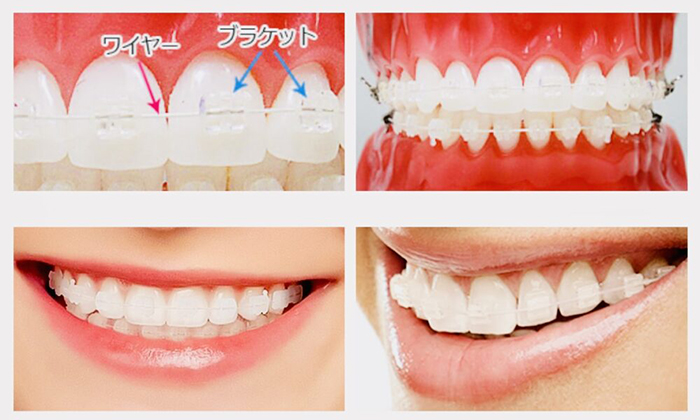 佐賀市の歯医者、佐賀ん歯科・こども歯科で矯正歯科