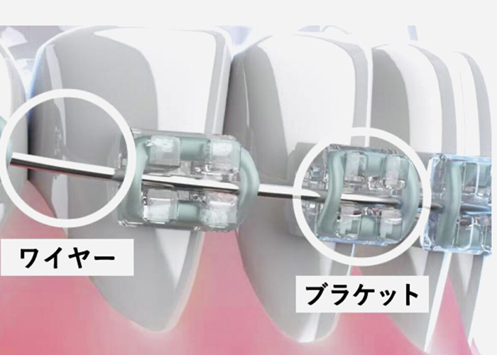 佐賀市の歯医者、佐賀ん歯科・こども歯科で矯正歯科