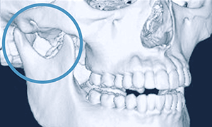 佐賀市の歯医者、佐賀ん歯科・こども歯科で無痛治療
