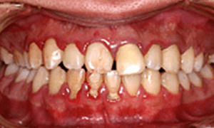 佐賀市の歯医者、佐賀ん歯科・こども歯科で無痛治療