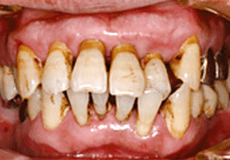佐賀市の歯医者、佐賀ん歯科・こども歯科で歯周病治療