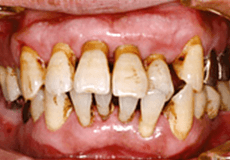 佐賀市の歯医者、佐賀ん歯科・こども歯科で歯周病治療