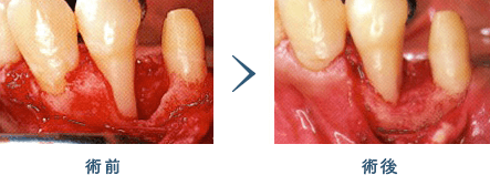 佐賀市の歯医者、佐賀ん歯科・こども歯科で歯周病治療