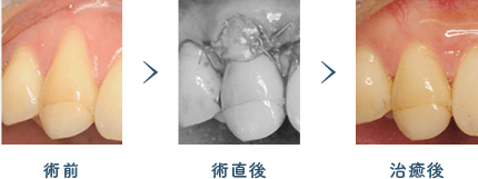 佐賀市の歯医者、佐賀ん歯科・こども歯科で歯周病治療
