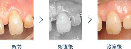 佐賀市の歯医者、佐賀ん歯科・こども歯科で歯周病治療