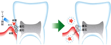 佐賀市の歯医者、佐賀ん歯科・こども歯科で歯周病治療