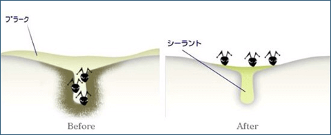 佐賀市の歯医者、佐賀ん歯科・こども歯科で予防歯科