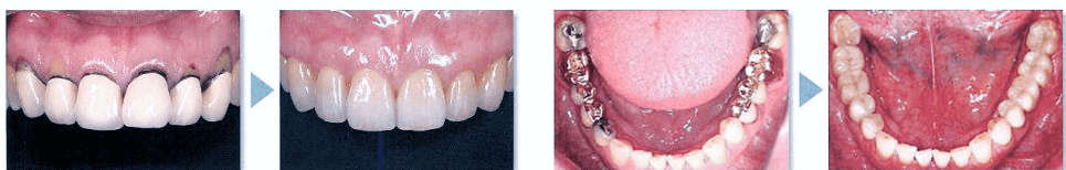 セラミックによる修復例
