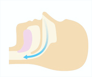 佐賀市の歯医者、佐賀ん歯科・こども歯科で睡眠時無呼吸症候群の治療
