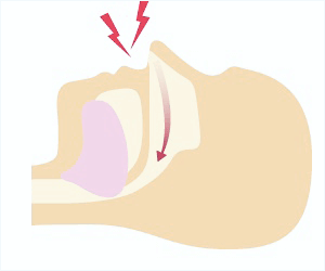 佐賀市の歯医者、佐賀ん歯科・こども歯科で睡眠時無呼吸症候群の治療
